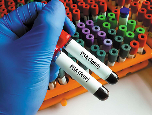 Finding advanced prostate cancers featured image