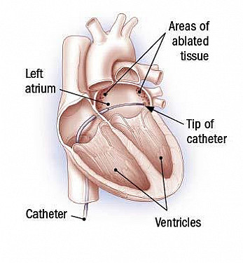 A faster, safer treatment for a common heart rhythm disorder? featured image